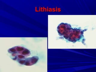 LithiasisLithiasis
 