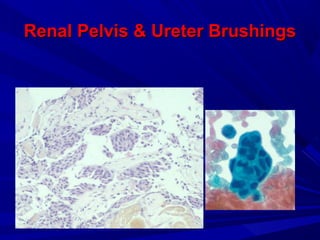 Renal Pelvis & Ureter BrushingsRenal Pelvis & Ureter Brushings
 