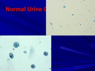 Normal Urine CytologyNormal Urine Cytology
 