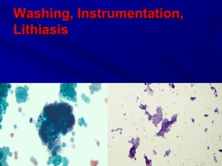 Washing, Instrumentation,Washing, Instrumentation,
LithiasisLithiasis
 