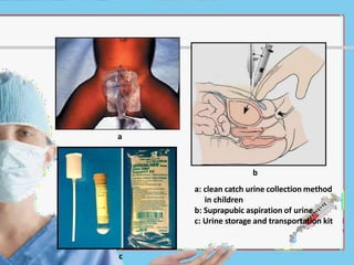 a
c
b
a: clean catch urine collection method
in children
b: Suprapubic aspiration of urine.
c: Urine storage and transportation kit
 
