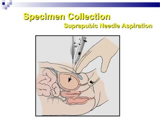 Specimen CollectionSpecimen Collection
Suprapubic Needle AspirationSuprapubic Needle Aspiration
 