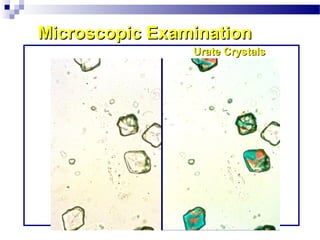 Microscopic ExaminationMicroscopic Examination
Urate CrystalsUrate Crystals
 