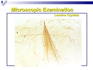 Microscopic ExaminationMicroscopic Examination
Leucine CrystalsLeucine Crystals
 