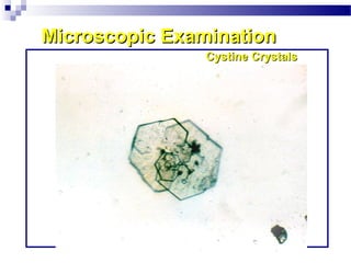 Microscopic ExaminationMicroscopic Examination
Cystine CrystalsCystine Crystals
 