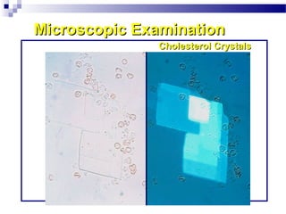 Microscopic ExaminationMicroscopic Examination
Cholesterol CrystalsCholesterol Crystals
 