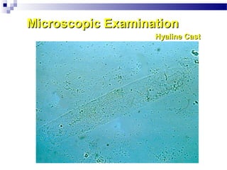 Microscopic ExaminationMicroscopic Examination
Hyaline CastHyaline Cast
 