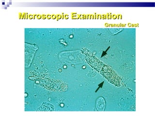 Microscopic ExaminationMicroscopic Examination
Granular CastGranular Cast
 
