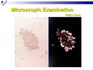 Microscopic ExaminationMicroscopic Examination
Fatty CastFatty Cast
 