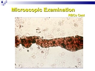 Microscopic ExaminationMicroscopic Examination
RBCs CastRBCs Cast
 