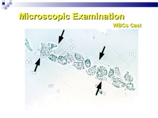Microscopic ExaminationMicroscopic Examination
WBCs CastWBCs Cast
 