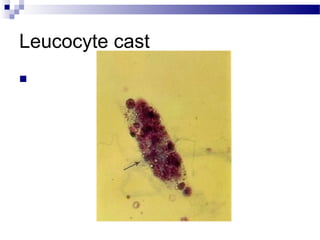 Leucocyte cast

 