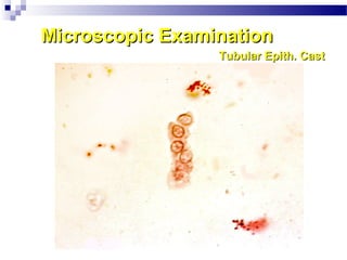 Microscopic ExaminationMicroscopic Examination
Tubular Epith. CastTubular Epith. Cast
 