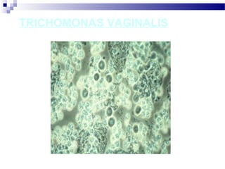 TRICHOMONAS VAGINALIS
 