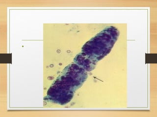 Erythrocyte cast
•
 