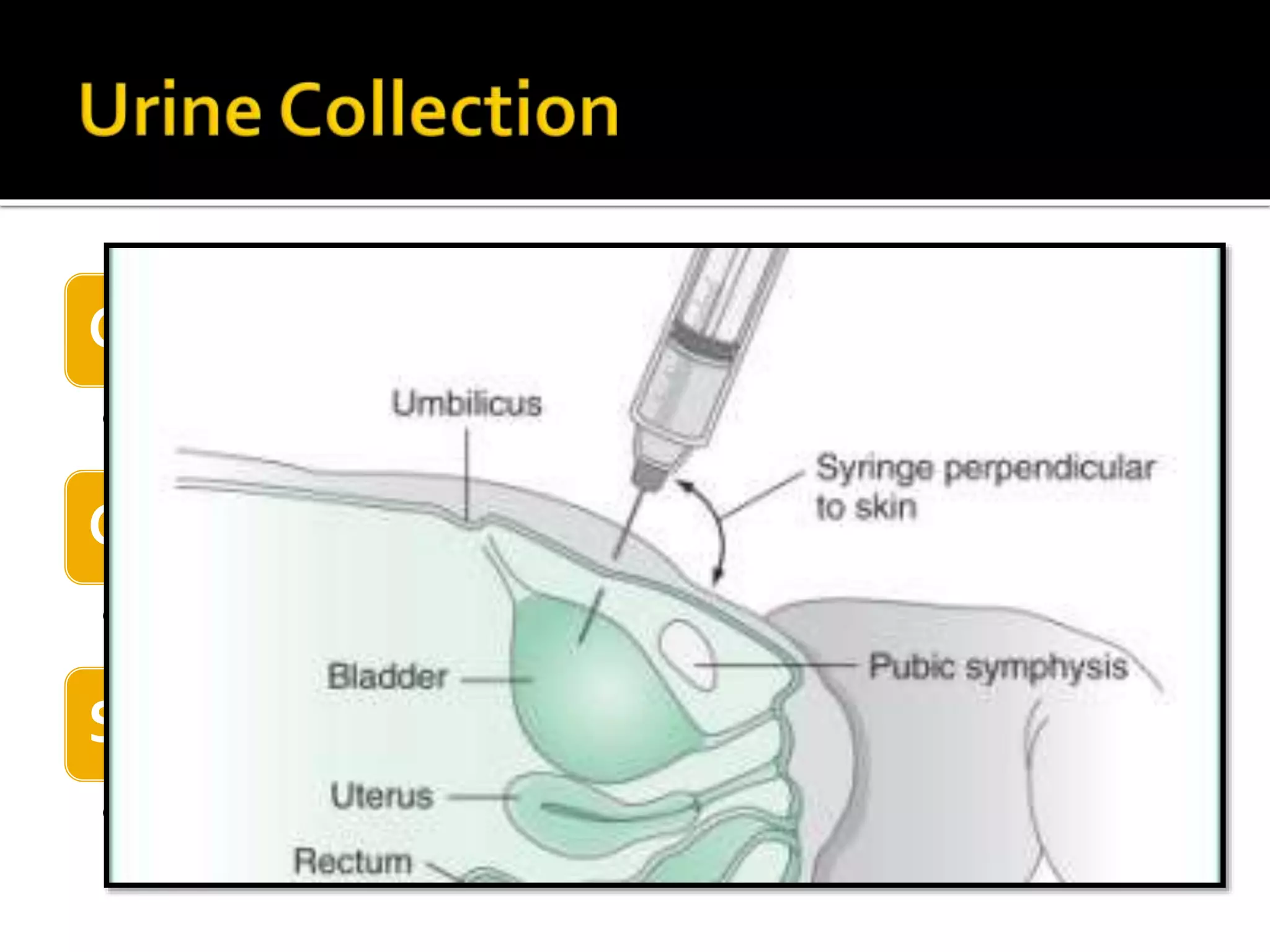 Clean catch midstream sample
• Specimen of choice (Routine + bacteriologic tests)
Catheterization of bladder
• in pts with difficult voiding
Suprapubic aspiration
• Infants & small children
 