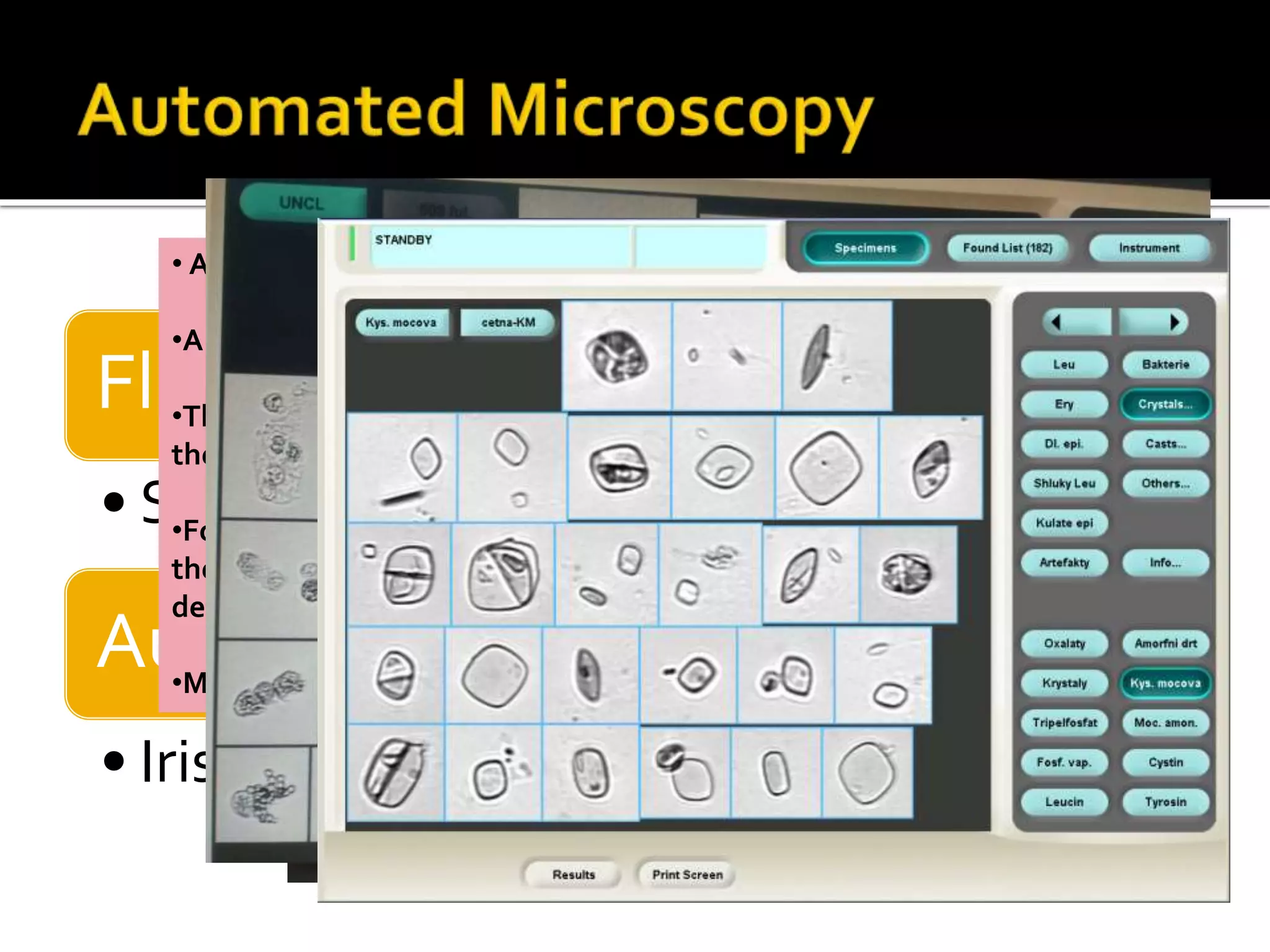 Flow cytometry
• Sysmex UF-50, 100
Auto Particle Recognition (APR)
• Iris Q200
• A known volume of urine passes in front of a microscope objective.
•A camera takes 500 fields per sample.
•The particles are classified using a model of a neural network used by
the software: Auto-Particle Recognition (APR™).
•For samples with very abnormal particles, a user can visually confirm
the identification of those particles according to their morphological
details seen on the screen
•Minimum size of the recognized particles is 3 μm
 