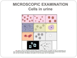 MICROSCOPIC EXAMINATION
Cells in urine
 