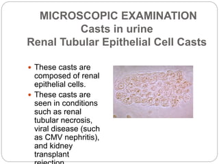 MICROSCOPIC EXAMINATION
Casts in urine
Renal Tubular Epithelial Cell Casts
 These casts are
composed of renal
epithelial ...