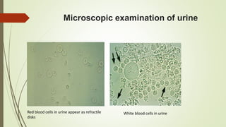 Microscopic examination of urine
Red blood cells in urine appear as refractile
disks
White blood cells in urine
 