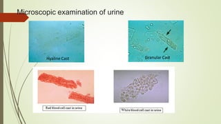 Microscopic examination of urine
Hyaline Cast Granular Cast
 