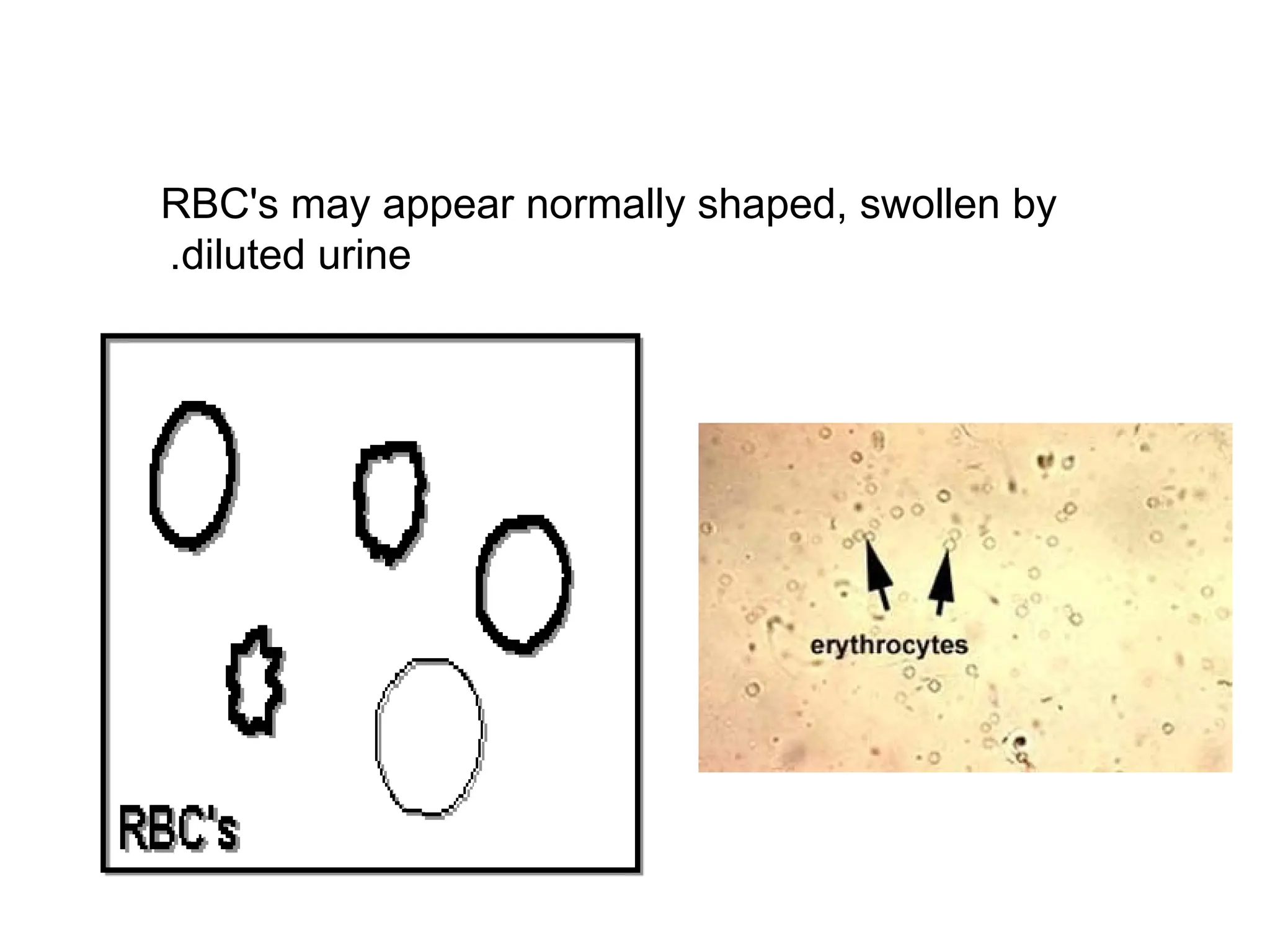 RBC's may appear normally shaped, swollen by
diluted urine
.
 