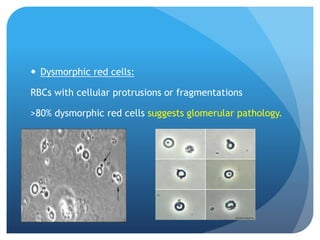  Dysmorphic red cells:
RBCs with cellular protrusions or fragmentations
>80% dysmorphic red cells suggests glomerular pathology.
 