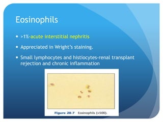 Eosinophils
 >1%-acute interstitial nephritis
 Appreciated in Wright’s staining.
 Small lymphocytes and histiocytes-renal transplant
rejection and chronic inflammation
 