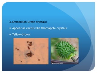 3.Ammonium Urate crystals:
 Appear as cactus like thornapple crystals
 Yellow-brown
 