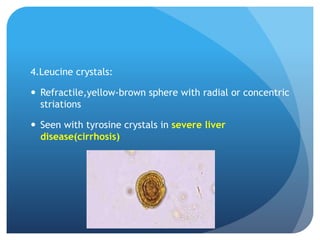 4.Leucine crystals:
 Refractile,yellow-brown sphere with radial or concentric
striations
 Seen with tyrosine crystals in severe liver
disease(cirrhosis)
 