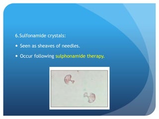 6.Sulfonamide crystals:
 Seen as sheaves of needles.
 Occur following sulphonamide therapy.
 