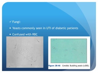  Fungi:
 Yeasts commonly seen in UTI of diabetic patients
 Confused with RBC
 