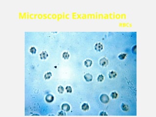 Microscopic Examination
RBCs
 