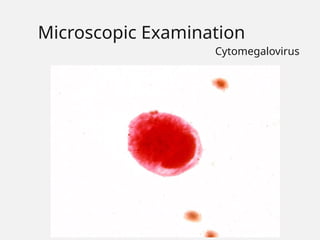 Microscopic Examination
Cytomegalovirus
 