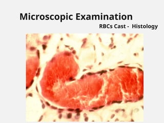 Microscopic Examination
RBCs Cast - Histology
 