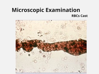 Microscopic Examination
RBCs Cast
 