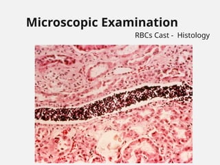 Microscopic Examination
RBCs Cast - Histology
 