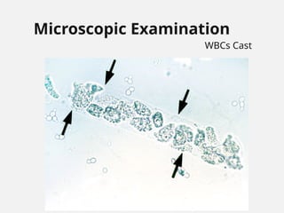 Microscopic Examination
WBCs Cast
 