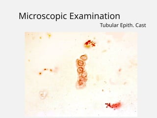 Microscopic Examination
Tubular Epith. Cast
 