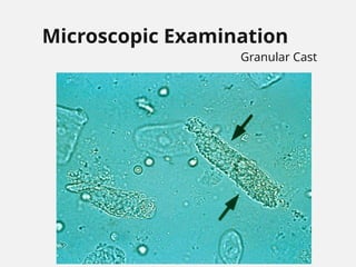 Microscopic Examination
Granular Cast
 
