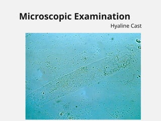 Microscopic Examination
Hyaline Cast
 