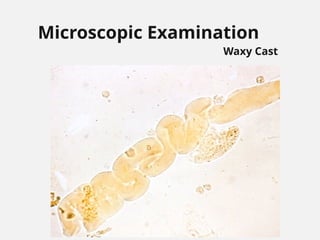 Microscopic Examination
Waxy Cast
 
