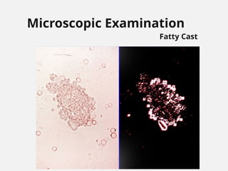 Microscopic Examination
Fatty Cast
 