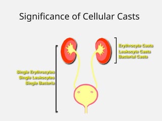 Bacterial Casts
Single Leukocytes
Leukocyte Casts
Single Erythrocytes
Erythrocyte Casts
Single Bacteria
Significance of Cellular Casts
 