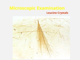 Microscopic Examination
Leucine Crystals
 