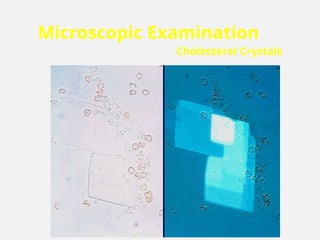Microscopic Examination
Cholesterol Crystals
 