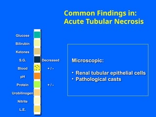 Common Findings in:
Acute Tubular Necrosis
Decreased
+ / -
+ / -
Microscopic:
• Renal tubular epithelial cells
• Pathological casts
Glucose
Bilirubin
Ketones
S.G.
Blood
pH
Protein
Nitrite
L.E.
Urobilinogen
 