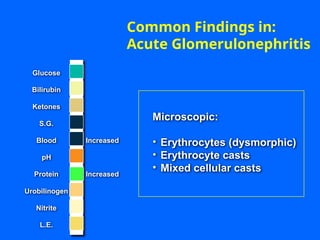 Increased
Increased
Microscopic:
• Erythrocytes (dysmorphic)
• Erythrocyte casts
• Mixed cellular casts
Common Findings in:
Acute Glomerulonephritis
Glucose
Bilirubin
Ketones
S.G.
Blood
pH
Protein
Nitrite
L.E.
Urobilinogen
 