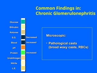 Decreased
Increased
Increased
Common Findings in:
Chronic Glomerulonephritis
Glucose
Bilirubin
Ketones
S.G.
Blood
pH
Protein
Nitrite
L.E.
Urobilinogen
Microscopic:
• Pathological casts
(broad waxy casts, RBCs)
 