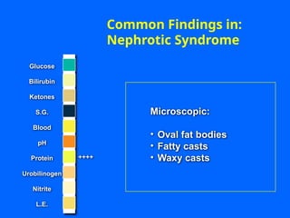 ++++
Microscopic:
• Oval fat bodies
• Fatty casts
• Waxy casts
Common Findings in:
Nephrotic Syndrome
Glucose
Bilirubin
Ketones
S.G.
Blood
pH
Protein
Nitrite
L.E.
Urobilinogen
 